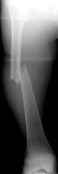 Figure 1_1314018-Femoral_Shaft AP